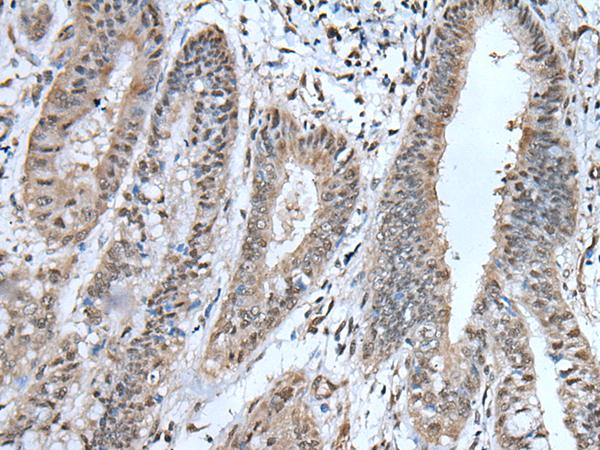 UBA52 Antibody - Immunohistochemistry of paraffin-embedded Human liver cancer tissue  using UBA52 Polyclonal Antibody at dilution of 1:55(×200)