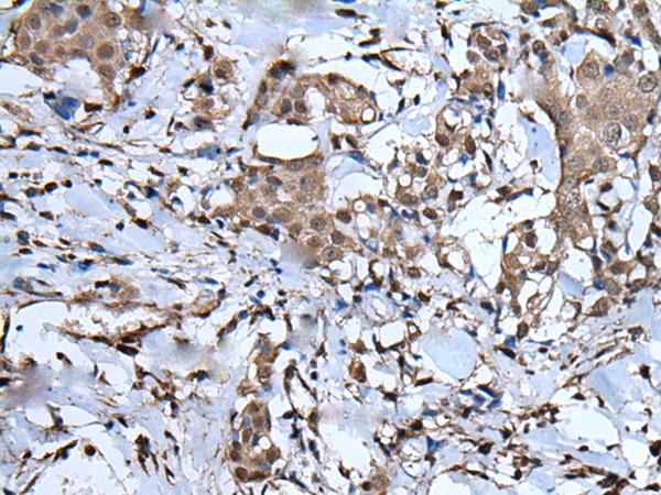 UBA52 Antibody - Immunohistochemistry of paraffin-embedded Human breast cancer tissue  using UBA52 Polyclonal Antibody at dilution of 1:55(×200)