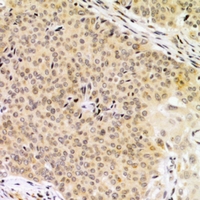 UBAC1 / KPC2 Antibody - Immunohistochemical analysis of KPC2 staining in human breast cancer formalin fixed paraffin embedded tissue section. The section was pre-treated using heat mediated antigen retrieval with sodium citrate buffer (pH 6.0). The section was then incubated with the antibody at room temperature and detected using an HRP conjugated compact polymer system. DAB was used as the chromogen. The section was then counterstained with haematoxylin and mounted with DPX.