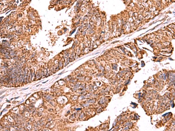 UBAC1 / KPC2 Antibody - Immunohistochemistry of paraffin-embedded Human colorectal cancer tissue  using UBAC1 Polyclonal Antibody at dilution of 1:60(×200)