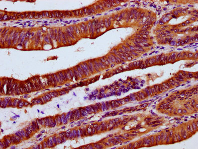 UBAC2 Antibody - Immunohistochemistry Dilution at 1:300 and staining in paraffin-embedded human colon cancer performed on a Leica BondTM system. After dewaxing and hydration, antigen retrieval was mediated by high pressure in a citrate buffer (pH 6.0). Section was blocked with 10% normal Goat serum 30min at RT. Then primary antibody (1% BSA) was incubated at 4°C overnight. The primary is detected by a biotinylated Secondary antibody and visualized using an HRP conjugated SP system.