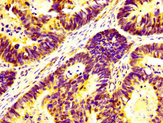 UBAP2L Antibody - Immunohistochemistry image at a dilution of 1:400 and staining in paraffin-embedded human ovarian cancer performed on a Leica BondTM system. After dewaxing and hydration, antigen retrieval was mediated by high pressure in a citrate buffer (pH 6.0) . Section was blocked with 10% normal goat serum 30min at RT. Then primary antibody (1% BSA) was incubated at 4 °C overnight. The primary is detected by a biotinylated secondary antibody and visualized using an HRP conjugated SP system.