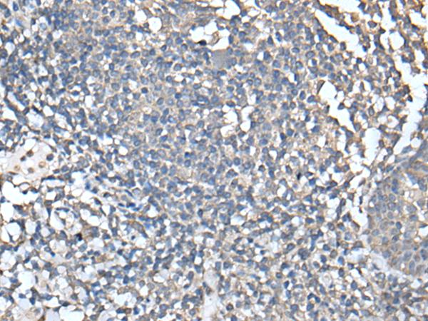 UBASH3A / CLIP4 Antibody - Immunohistochemistry of paraffin-embedded Human tonsil tissue  using UBASH3A Polyclonal Antibody at dilution of 1:50(×200)