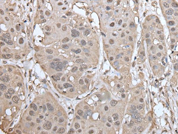 UBASH3A / CLIP4 Antibody - Immunohistochemistry of paraffin-embedded Human esophagus cancer tissue  using UBASH3A Polyclonal Antibody at dilution of 1:50(×200)