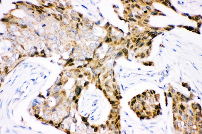 UBB / Ubiquitin B Antibody - Ubiquitin antibody IHC-paraffin: Human Mammary Cancer Tissue.