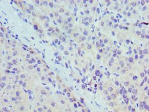 UBC6 / UBE2J2 Antibody - Immunohistochemistry of paraffin-embedded human liver cancer using antibody at 1:100 dilution.
