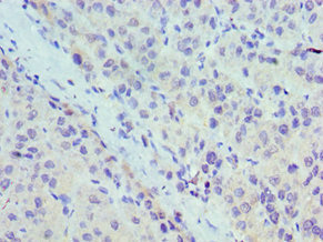 UBC6 / UBE2J2 Antibody - Immunohistochemistry of paraffin-embedded human liver cancer using UBE2J2 Antibody at dilution of 1:100