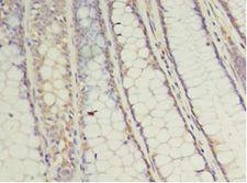 UBCH10 / UBE2C Antibody - Immunohistochemistry of paraffin-embedded human colon cancer tissue using antibody at 1:100 dilution.  This image was taken for the unconjugated form of this product. Other forms have not been tested.