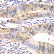 UBCH10 / UBE2C Antibody - Immunohistochemistry of paraffin-embedded human colon carcinoma tissue.