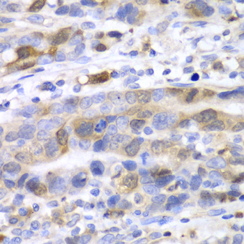 UBCH10 / UBE2C Antibody - Immunohistochemistry of paraffin-embedded human gastric cancer tissue.