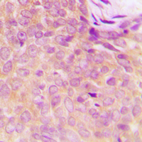 UBE1DC1 / UBA5 Antibody - Immunohistochemical analysis of UBA5 staining in human breast cancer formalin fixed paraffin embedded tissue section. The section was pre-treated using heat mediated antigen retrieval with sodium citrate buffer (pH 6.0). The section was then incubated with the antibody at room temperature and detected using an HRP-conjugated compact polymer system. DAB was used as the chromogen. The section was then counterstained with hematoxylin and mounted with DPX.