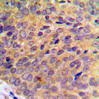 UBE1L / UBA7 Antibody - Immunohistochemical analysis of UBA7 staining in human breast cancer formalin fixed paraffin embedded tissue section. The section was pre-treated using heat mediated antigen retrieval with sodium citrate buffer (pH 6.0). The section was then incubated with the antibody at room temperature and detected using an HRP conjugated compact polymer system. DAB was used as the chromogen. The section was then counterstained with hematoxylin and mounted with DPX.