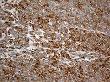 UBE1L / UBA7 Antibody - Immunohistochemical staining of paraffin-embedded Adenocarcinoma of Human breast tissue tissue using anti-UBA7 mouse monoclonal antibody. (Heat-induced epitope retrieval by 1mM EDTA in 10mM Tris buffer. (pH8.5) at 120°C for 3 min. (1:500)