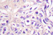 UBE1L / UBA7 Antibody - IHC of UBE1L (E996) pAb in paraffin-embedded human lung carcinoma tissue.