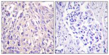 UBE1L / UBA7 Antibody - Peptide - + Immunohistochemistry analysis of paraffin-embedded human breast carcinoma tissue using UBE1L antibody.