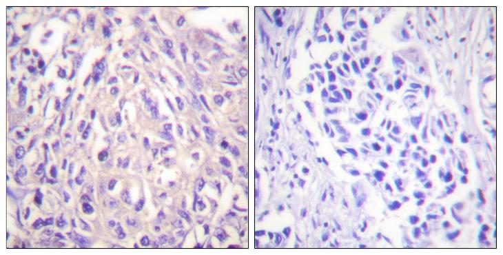 UBE1L / UBA7 Antibody - Peptide - + Immunohistochemistry analysis of paraffin-embedded human breast carcinoma tissue using UBE1L antibody.
