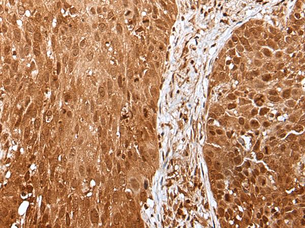 UBE1L / UBA7 Antibody - Immunohistochemistry of paraffin-embedded Human lung cancer tissue  using UBA7 Polyclonal Antibody at dilution of 1:35(×200)