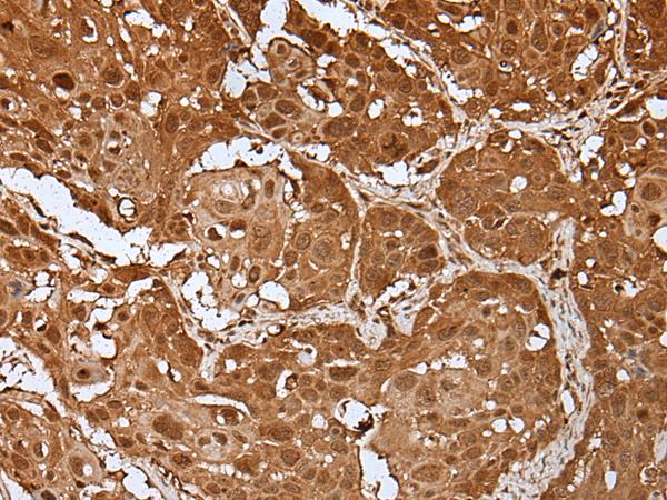 UBE1L / UBA7 Antibody - Immunohistochemistry of paraffin-embedded Human esophagus cancer tissue  using UBA7 Polyclonal Antibody at dilution of 1:35(×200)