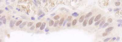 UBE2A Antibody - Detection of Human Rad6 by Immunohistochemistry. Sample: FFPE section of human stomach carcinoma. Antibody: Affinity purified rabbit anti-Rad6 used at a dilution of 1:1000 (1 ug/ml). Detection: DAB.