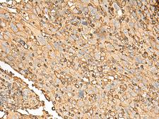 UBE2A Antibody - Immunohistochemistry of paraffin-embedded Human cervical cancer tissue  using UBE2A Polyclonal Antibody at dilution of 1:45(×200)