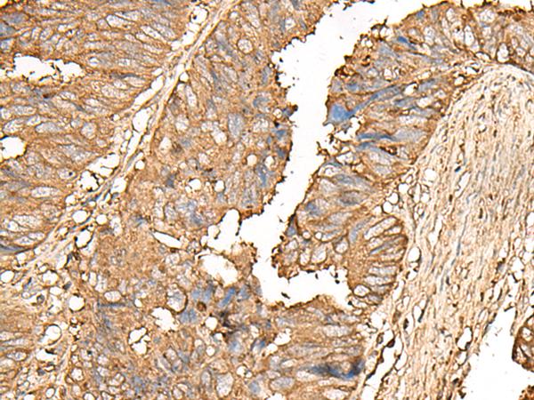 UBE2A Antibody - Immunohistochemistry of paraffin-embedded Human colorectal cancer tissue  using UBE2A Polyclonal Antibody at dilution of 1:55(×200)