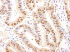 UBE2A Antibody - Detection of human Rad6 by Immunohistochemistry. Sample: FFPE section of human stomach adenocarcinoma. Antibody: Affinity purified rabbit anti-Rad6 used at a dilution of 1:250. Detection: DAB staining using anti-Rabbit IHC antibody at a dilution of 1:100.