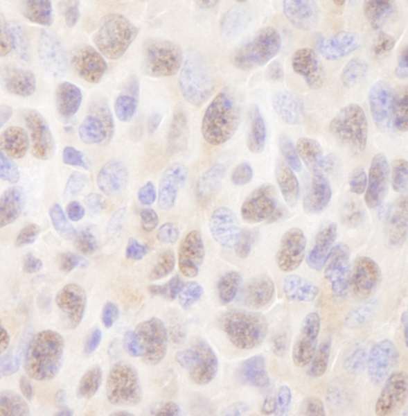 UBE2A Antibody - Detection of Mouse Rad6 by Immunohistochemistry. Sample: FFPE section of mouse squamous cell carcinoma. Antibody: Affinity purified rabbit anti-Rad6 used at a dilution of 1:250. Detection: DAB staining using anti-Rabbit IHC antibody at a dilution of 1:100.