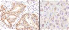 UBE2A Antibody - Detection of Human and Mouse Rad6 by Immunohistochemistry. Sample: FFPE section of human stomach carcinoma (left) and mouse squamous cell carcinoma (right). Antibody: Affinity purified rabbit anti-Rad6 used at a dilution of 1:1000 (1 ug/ml). Detection: DAB.