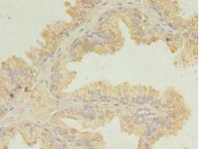 UBE2D1 / UBCH5 Antibody - Immunohistochemistry of paraffin-embedded human prostate cancer using antibody at 1:100 dilution.  This image was taken for the unconjugated form of this product. Other forms have not been tested.