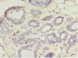 UBE2D1 / UBCH5 Antibody - Immunohistochemistry of paraffin-embedded human breast cancer using antibody at 1: 100 dilution.  This image was taken for the unconjugated form of this product. Other forms have not been tested.
