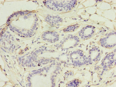 UBE2D1 / UBCH5 Antibody - Immunohistochemistry of paraffin-embedded human breast cancer using UBE2D1 Antibody at dilution of 1:100