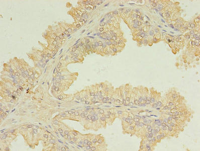 UBE2D1 / UBCH5 Antibody - Immunohistochemistry of paraffin-embedded human prostate cancer using UBE2D1 Antibody at dilution of 1:100