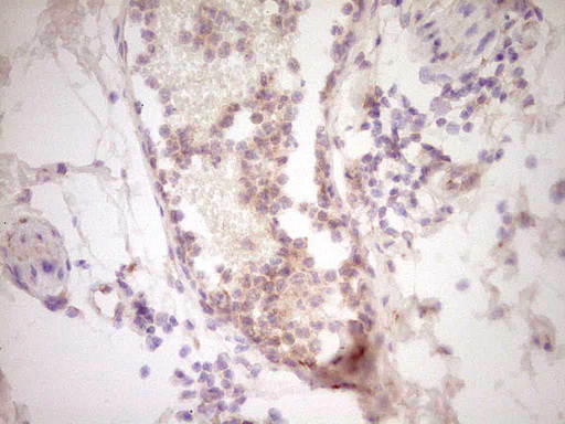UBE2D2 / UBCH5B Antibody - Immunohistochemical staining of paraffin-embedded Human bladder tissue within the normal limits using anti-UBE2D2 mouse monoclonal antibody. (Heat-induced epitope retrieval by 1 mM EDTA in 10mM Tris, pH8.5, 120C for 3min,