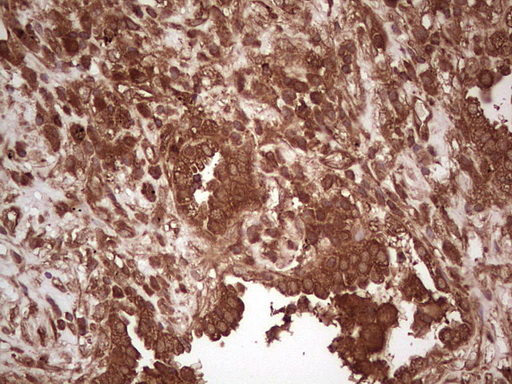 UBE2D2 / UBCH5B Antibody - Immunohistochemical staining of paraffin-embedded Carcinoma of Human lung tissue using anti-UBE2D2 mouse monoclonal antibody. (Heat-induced epitope retrieval by 1 mM EDTA in 10mM Tris, pH8.5, 120C for 3min,