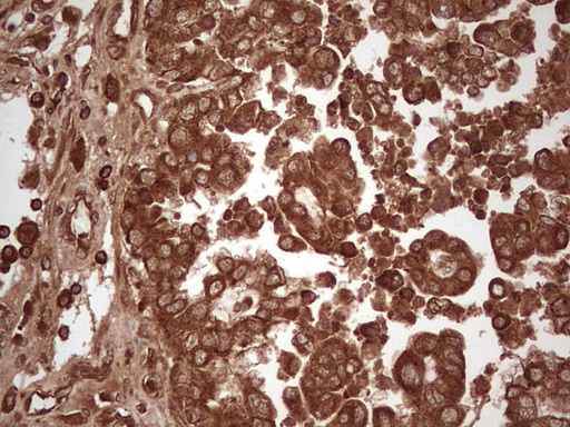 UBE2D2 / UBCH5B Antibody - Immunohistochemical staining of paraffin-embedded Adenocarcinoma of Human ovary tissue using anti-UBE2D2 mouse monoclonal antibody. (Heat-induced epitope retrieval by 1 mM EDTA in 10mM Tris, pH8.5, 120C for 3min,