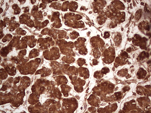 UBE2D2 / UBCH5B Antibody - Immunohistochemical staining of paraffin-embedded Carcinoma of Human pancreas tissue using anti-UBE2D2 mouse monoclonal antibody. (Heat-induced epitope retrieval by 1 mM EDTA in 10mM Tris, pH8.5, 120C for 3min,