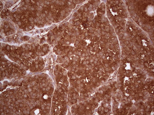 UBE2D2 / UBCH5B Antibody - Immunohistochemical staining of paraffin-embedded Carcinoma of Human thyroid tissue using anti-UBE2D2 mouse monoclonal antibody. (Heat-induced epitope retrieval by 1 mM EDTA in 10mM Tris, pH8.5, 120C for 3min,