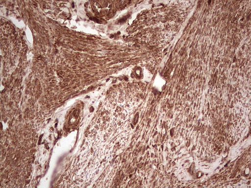 UBE2D2 / UBCH5B Antibody - Immunohistochemical staining of paraffin-embedded Adenocarcinoma of Human endometrium tissue using anti-UBE2D2 mouse monoclonal antibody. (Heat-induced epitope retrieval by 1 mM EDTA in 10mM Tris, pH8.5, 120C for 3min,