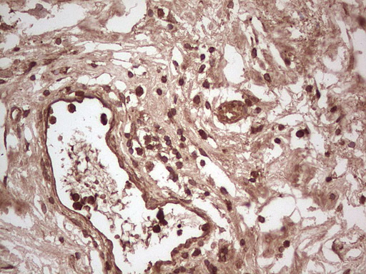 UBE2D2 / UBCH5B Antibody - Immunohistochemical staining of paraffin-embedded Carcinoma of Human bladder tissue using anti-UBE2D2 mouse monoclonal antibody. (Heat-induced epitope retrieval by 1 mM EDTA in 10mM Tris, pH8.5, 120C for 3min,