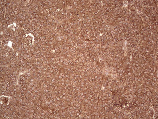 UBE2D2 / UBCH5B Antibody - Immunohistochemical staining of paraffin-embedded Human lymphoma tissue using anti-UBE2D2 mouse monoclonal antibody. (Heat-induced epitope retrieval by 1 mM EDTA in 10mM Tris, pH8.5, 120C for 3min,