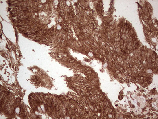 UBE2D2 / UBCH5B Antibody - Immunohistochemical staining of paraffin-embedded Adenocarcinoma of Human colon tissue using anti-UBE2D2 mouse monoclonal antibody. (Heat-induced epitope retrieval by 1 mM EDTA in 10mM Tris, pH8.5, 120C for 3min,