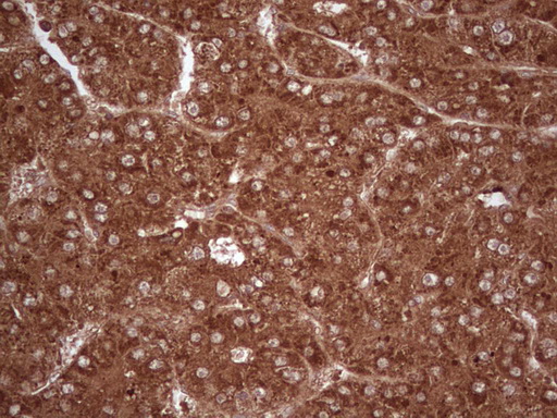UBE2D2 / UBCH5B Antibody - Immunohistochemical staining of paraffin-embedded Carcinoma of Human liver tissue using anti-UBE2D2 mouse monoclonal antibody. (Heat-induced epitope retrieval by 1 mM EDTA in 10mM Tris, pH8.5, 120C for 3min,