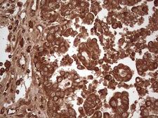 UBE2D2 / UBCH5B Antibody - IHC of paraffin-embedded Adenocarcinoma of Human ovary tissue using anti-UBE2D2 mouse monoclonal antibody. (Heat-induced epitope retrieval by 1 mM EDTA in 10mM Tris, pH8.5, 120°C for 3min).