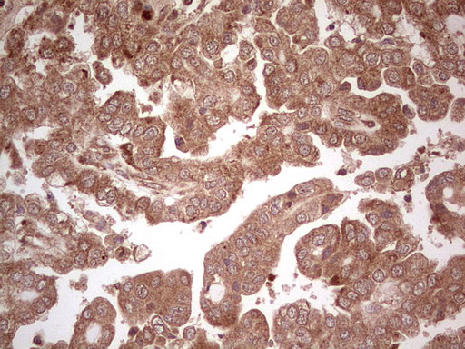UBE2D2 / UBCH5B Antibody - Immunohistochemical staining of paraffin-embedded Adenocarcinoma of Human ovary tissue using anti-UBE2D2 mouse monoclonal antibody. (Heat-induced epitope retrieval by 1 mM EDTA in 10mM Tris, pH8.5, 120C for 3min,