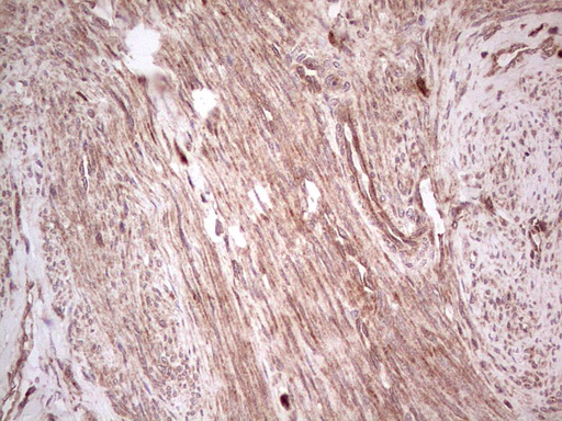 UBE2D2 / UBCH5B Antibody - Immunohistochemical staining of paraffin-embedded Adenocarcinoma of Human endometrium tissue using anti-UBE2D2 mouse monoclonal antibody. (Heat-induced epitope retrieval by 1 mM EDTA in 10mM Tris, pH8.5, 120C for 3min,