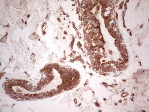 UBE2D2 / UBCH5B Antibody - Immunohistochemical staining of paraffin-embedded Adenocarcinoma of Human breast tissue using anti-UBE2D2 mouse monoclonal antibody. (Heat-induced epitope retrieval by 1 mM EDTA in 10mM Tris, pH8.5, 120C for 3min,