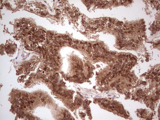 UBE2D2 / UBCH5B Antibody - Immunohistochemical staining of paraffin-embedded Carcinoma of Human prostate tissue using anti-UBE2D2 mouse monoclonal antibody. (Heat-induced epitope retrieval by 1 mM EDTA in 10mM Tris, pH8.5, 120C for 3min,