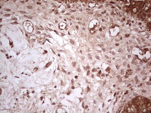 UBE2D2 / UBCH5B Antibody - Immunohistochemical staining of paraffin-embedded Carcinoma of Human bladder tissue using anti-UBE2D2 mouse monoclonal antibody. (Heat-induced epitope retrieval by 1 mM EDTA in 10mM Tris, pH8.5, 120C for 3min,