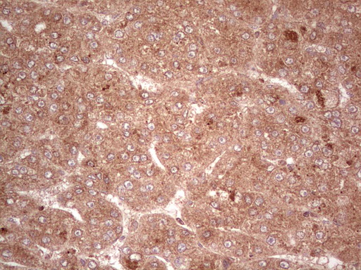 UBE2D2 / UBCH5B Antibody - Immunohistochemical staining of paraffin-embedded Carcinoma of Human liver tissue using anti-UBE2D2 mouse monoclonal antibody. (Heat-induced epitope retrieval by 1 mM EDTA in 10mM Tris, pH8.5, 120C for 3min,