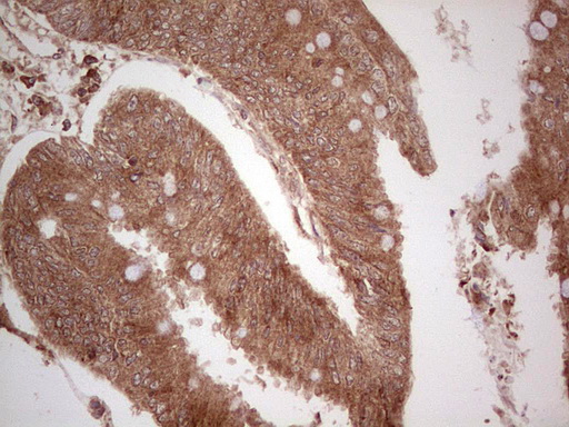 UBE2D2 / UBCH5B Antibody - IHC of paraffin-embedded Adenocarcinoma of Human colon tissue using anti-UBE2D2 mouse monoclonal antibody. (Heat-induced epitope retrieval by 1 mM EDTA in 10mM Tris, pH8.5, 120°C for 3min).
